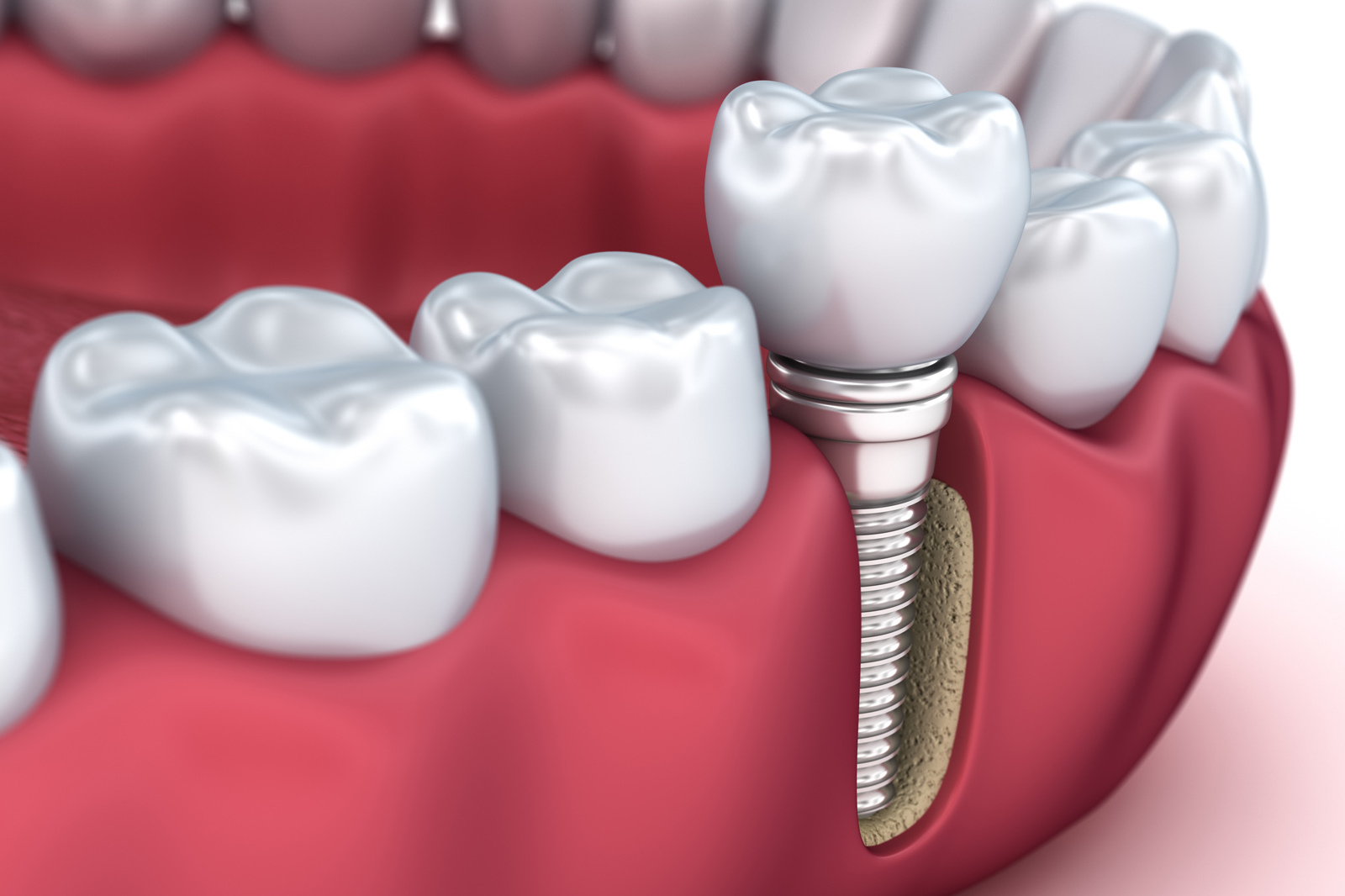 Journey to a New Smile: The Science Behind Dental Implants